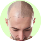 Hair transplant icon